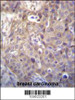HIPK1 Antibody immunohistochemistry analysis in formalin fixed and paraffin embedded human breast carcinoma followed by peroxidase conjugation of the secondary antibody and DAB staining.
