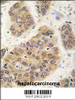 Formalin-fixed and paraffin-embedded human hepatocarcinoma tissue reacted with SUMO4 antibody (M55 Wild type) , which was peroxidase-conjugated to the secondary antibody, followed by DAB staining.