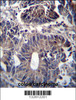 ZFYVE19 Antibody immunohistochemistry analysis in formalin fixed and paraffin embedded human colon carcinoma followed by peroxidase conjugation of the secondary antibody and DAB staining.