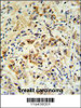 mouse BID Antibody (S61) IHC analysis in formalin fixed and paraffin embedded human breast carcinoma followed by peroxidase conjugation of the secondary antibody and DAB staining. This data demonstrates the use of the mouse BID Antibody (S61) for immunohistochemistry.