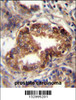 RAB3D Antibody immunohistochemistry analysis in formalin fixed and paraffin embedded human prostate carcinoma followed by peroxidase conjugation of the secondary antibody and DAB staining.