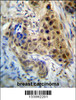 RPL3 Antibody immunohistochemistry analysis in formalin fixed and paraffin embedded human breast carcinoma followed by peroxidase conjugation of the secondary antibody and DAB staining.