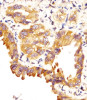 Antibody staining SFTPC in human lung adenocarcinoma sections by Immunohistochemistry (IHC-P - paraformaldehyde-fixed, paraffin-embedded sections) .