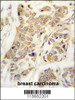 Formalin-fixed and paraffin-embedded human breast carcinoma tissue reacted with CDH8 antibody, which was peroxidase-conjugated to the secondary antibody, followed by DAB staining.