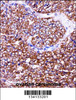 BAG2 Antibody immunohistochemistry analysis in formalin fixed and paraffin embedded human ovarian carcinoma followed by peroxidase conjugation of the secondary antibody and DAB staining.