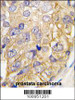 Formalin-fixed and paraffin-embedded human prostata carcinoma tissue reacted with DRAGON (RGMB) , which was peroxidase-conjugated to the secondary antibody, followed by DAB staining.