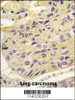 Formalin-fixed and paraffin-embedded human lung carcinoma tissue reacted with FRAT1 antibody, which was peroxidase-conjugated to the secondary antibody, followed by DAB staining.