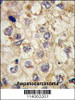 Formalin-fixed and paraffin-embedded human hepatocarcinoma tissue reacted with SSR1 antibody, which was peroxidase-conjugated to the secondary antibody, followed by DAB staining.