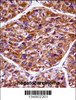 EIF2AK3 Antibody immunohistochemistry analysis in formalin fixed and paraffin embedded human hepatocarcinoma followed by peroxidase conjugation of the secondary antibody and DAB staining.