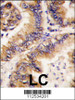 Formalin-fixed and paraffin-embedded human lung carcinoma tissue reacted with TRAPPC4 antibody, which was peroxidase-conjugated to the secondary antibody, followed by DAB staining.
