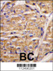 Formalin-fixed and paraffin-embedded human breast carcinoma tissue reacted with MIPEP antibody, which was peroxidase-conjugated to the secondary antibody, followed by DAB staining.