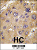 Formalin-fixed and paraffin-embedded human hepatocarcinoma tissue reacted with *ALDH6A1 antibody, which was peroxidase-conjugated to the secondary antibody, followed by DAB staining.