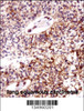 ECT2 Antibody immunohistochemistry analysis in formalin fixed and paraffin embedded human lung squamous carcinoma followed by peroxidase conjugation of the secondary antibody and DAB staining.