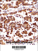 ORC3L Antibody immunohistochemistry analysis in formalin fixed and paraffin embedded human lung adenocarcinoma followed by peroxidase conjugation of the secondary antibody and DAB staining.