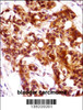 KRT7 Antibody immunohistochemistry analysis in formalin fixed and paraffin embedded human bladder carcinoma followed by peroxidase conjugation of the secondary antibody and DAB staining.