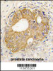 Formalin-fixed and paraffin-embedded human prostata carcinoma tissue reacted with CDH3 antibody, which was peroxidase-conjugated to the secondary antibody, followed by DAB staining.