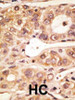 Formalin-fixed and paraffin-embedded human cancer tissue reacted with the primary antibody, which was peroxidase-conjugated to the secondary antibody, followed by AEC staining. BC = breast carcinoma; HC = hepatocarcinoma.