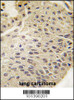 Formalin-fixed and paraffin-embedded human lung carcinoma tissue reacted with GJB5 Antibody, which was peroxidase-conjugated to the secondary antibody, followed by DAB staining.