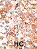 Formalin-fixed and paraffin-embedded human cancer tissue reacted with the primary antibody, which was peroxidase-conjugated to the secondary antibody, followed by DAB staining. BC = breast carcinoma; HC = hepatocarcinoma.