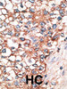 Formalin-fixed and paraffin-embedded human cancer tissue reacted with the primary antibody, which was peroxidase-conjugated to the secondary antibody, followed by AEC staining. BC = breast carcinoma; HC = hepatocarcinoma.