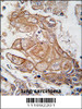 Formalin-fixed and paraffin-embedded human lung carcinoma tissue reacted with Phospho-RGS19-pS151.ctrl antibody, which was peroxidase-conjugated to the secondary antibody, followed by DAB staining.