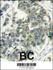 Formalin-fixed and paraffin-embedded human breast carcinoma reacted with EIF4E antibody (N-term) , which was peroxidase-conjugated to the secondary antibody, followed by DAB staining.