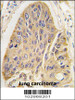 Formalin-fixed and paraffin-embedded human lung carcinoma tissue reacted with hMAP2-Q425 antibody, which was peroxidase-conjugated to the secondary antibody, followed by DAB staining.