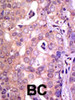 Formalin-fixed and paraffin-embedded human cancer tissue reacted with the primary antibody, which was peroxidase-conjugated to the secondary antibody, followed by AEC staining. BC = breast carcinoma; HC = hepatocarcinoma.