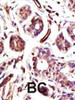 Formalin-fixed and paraffin-embedded human cancer tissue reacted with the primary antibody, which was peroxidase-conjugated to the secondary antibody, followed by DAB staining. BC = breast carcinoma; HC = hepatocarcinoma.