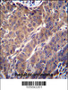 ARL2 Antibody immunohistochemistry analysis in formalin fixed and paraffin embedded human hepatocarcinoma followed by peroxidase conjugation of the secondary antibody and DAB staining.