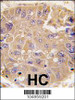 Formalin-fixed and paraffin-embedded human hepatocarcinoma tissue reacted with METAP2 antibody, which was peroxidase-conjugated to the secondary antibody, followed by DAB staining.