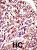 Formalin-fixed and paraffin-embedded human cancer tissue reacted with the primary antibody, which was peroxidase-conjugated to the secondary antibody, followed by AEC staining. BC = breast carcinoma; HC = hepatocarcinoma.