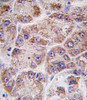 Formalin-fixed and paraffin-embedded human hepatocarcinoma tissue reacted with FDPS antibody (Center ) , which was peroxidase-conjugated to the secondary antibody, followed by DAB staining.