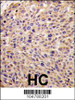 Formalin-fixed and paraffin-embedded human hepatocarcinoma tissue reacted with GGPS1 Antibody (N-term) , which was peroxidase-conjugated to the secondary antibody, followed by DAB staining.