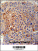 GPLD1 Antibody immunohistochemistry analysis in formalin fixed and paraffin embedded human hepatocarcinoma tissue followed by peroxidase conjugation of the secondary antibody and DAB staining.