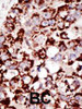 Formalin-fixed and paraffin-embedded human cancer tissue reacted with the primary antibody, which was peroxidase-conjugated to the secondary antibody, followed by DAB staining. BC = breast carcinoma; HC = hepatocarcinoma.