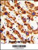 Formalin-fixed and paraffin-embedded human hepatocarcinoma with Prohibitin (PHB1) Antibody (N-term) , which was peroxidase-conjugated to the secondary antibody, followed by DAB staining.