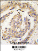 Formalin-fixed and paraffin-embedded human lung carcinoma tissue reacted with Olfm1 Antibody, which was peroxidase-conjugated to the secondary antibody, followed by DAB staining.