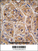 Formalin-fixed and paraffin-embedded human hepatocarcinoma tissue reacted with AKR1A1 antibody, which was peroxidase-conjugated to the secondary antibody, followed by DAB staining.