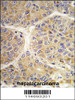 Formalin-fixed and paraffin-embedded human hepatocarcinoma tissue reacted with the AASS antibody, which was peroxidase-conjugated to the secondary antibody, followed by DAB staining.