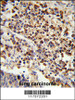 Formalin-fixed and paraffin-embedded human lung carcinoma reacted with, which was peroxidase-conjugated to the secondary antibody, followed by DAB staining.