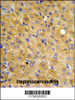 DLG7 Antibody IHC analysis in formalin fixed and paraffin embedded hepatocarcinoma followed by peroxidase conjugation of the secondary antibody and DAB staining.