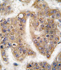 Formalin-fixed and paraffin-embedded human hepatocarcinoma tissue reacted with TRAIP antibody, which was peroxidase-conjugated to the secondary antibody, followed by DAB staining.