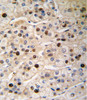 Formalin-fixed and paraffin-embedded human hepatocarcinoma tissue reacted with PCNA antibody, which was peroxidase-conjugated to the secondary antibody, followed by DAB staining.