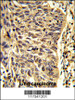 Formalin-fixed and paraffin-embedded human lung carcinoma reacted with SNRPD1 Antibody, which was peroxidase-conjugated to the secondary antibody, followed by DAB staining.