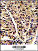 Formalin-fixed and paraffin-embedded human hepatocarcinoma reacted with ENOB Antibody, which was peroxidase-conjugated to the secondary antibody, followed by DAB staining.