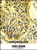 Formalin-fixed and paraffin-embedded human lung carcinoma with CD201 Antibody, which was peroxidase-conjugated to the secondary antibody, followed by DAB staining.