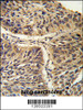Formalin-fixed and paraffin-embedded human lung carcinoma reacted with CCT3 Antibody, which was peroxidase-conjugated to the secondary antibody, followed by DAB staining.