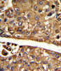 Formalin-fixed and paraffin-embedded human hepatocarcinoma reacted with MDH1 Antibody, which was peroxidase-conjugated to the secondary antibody, followed by DAB staining.
