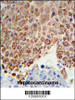 PHGDH Antibody immunohistochemistry analysis in formalin fixed and paraffin embedded human hepatocarcinoma followed by peroxidase conjugation of the secondary antibody and DAB staining.